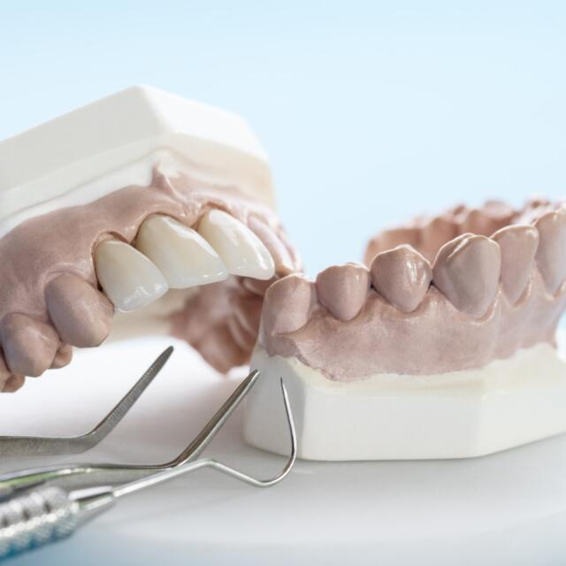 Metal Destekli Protezler: Güçlü ve Dayanıklı Bir Seçenek